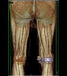 Runoff Study- See Sequence - CTisus CT Scan