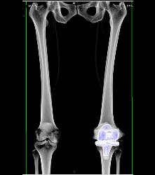 Runoff Study- See Sequence - CTisus CT Scan