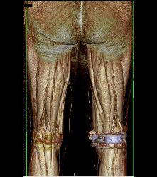 Runoff Study- See Sequence - CTisus CT Scan