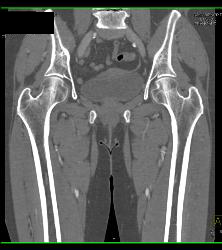 Runoff Study- See Sequence - CTisus CT Scan