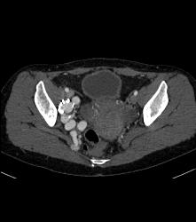 Pelvic Arteriovenous Malformation (AVM) Involves Bone - CTisus CT Scan