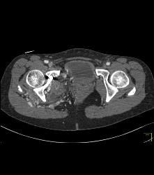 Pelvic Arteriovenous Malformation (AVM) Involves Bone - CTisus CT Scan