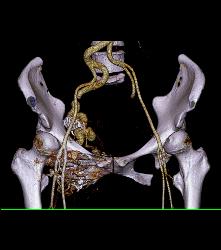 Pelvic Arteriovenous Malformation (AVM) Involves Bone - CTisus CT Scan