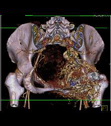 Pelvic Arteriovenous Malformation (AVM) Involves Bone - CTisus CT Scan