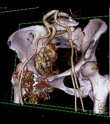 Pelvic Arteriovenous Malformation (AVM) Involves Bone - CTisus CT Scan