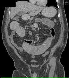 Ischemic Bowel With Subtle Superior Mesenteric Artery (SMA) Thrombosis- See Sequence - CTisus CT Scan