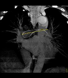 Incidental Broken Catheter in Pulmonary Artery - CTisus CT Scan