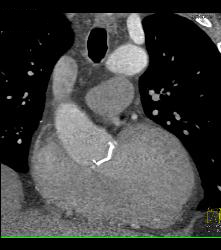 Incidental Broken Catheter in Pulmonary Artery - CTisus CT Scan