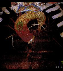 Incidental Broken Catheter in Pulmonary Artery - CTisus CT Scan