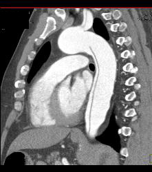 Aortic Dissection - CTisus CT Scan