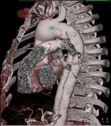 Aortic Dissection - CTisus CT Scan