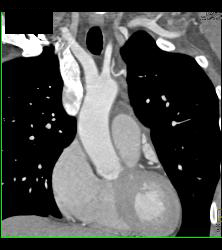 Prominent But Normal Atrial Appendage - CTisus CT Scan