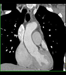 Prominent But Normal Atrial Appendage - CTisus CT Scan