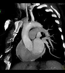 Prominent But Normal Atrial Appendage - CTisus CT Scan