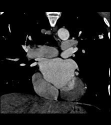 Tuberculoma in Left Upper Lung Simulates A Pulmonary Arteriovenous Malformation (PAVM) - CTisus CT Scan