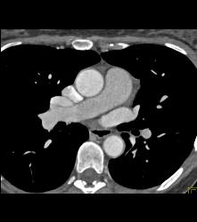 Thickening Descending Aorta in Takayasu's Arteritis - CTisus CT Scan