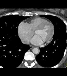 Thickening Descending Aorta in Takayasu's Arteritis - CTisus CT Scan