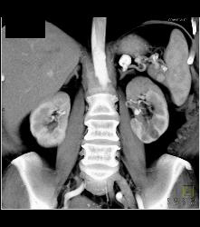 Renal Artery Aneurysm - CTisus CT Scan