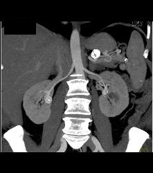 Renal Artery Aneurysm - CTisus CT Scan