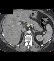 Renal Artery Aneurysm - CTisus CT Scan