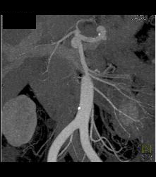 Renal Artery Aneurysm - CTisus CT Scan