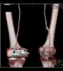 Peripheral Vascular Disease (PVD) on Runoff - CTisus CT Scan