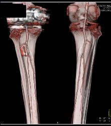 Peripheral Vascular Disease (PVD) on Runoff - CTisus CT Scan