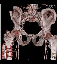 Peripheral Vascular Disease (PVD) on Runoff - CTisus CT Scan