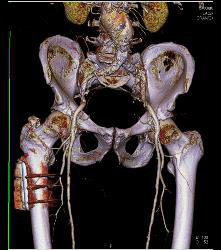 Peripheral Vascular Disease (PVD) on Runoff - CTisus CT Scan