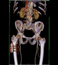 Peripheral Vascular Disease (PVD) on Runoff - CTisus CT Scan