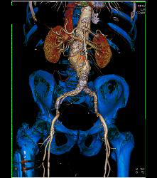 Abdominal Aortic Aneurysm (AAA) With Peripheral Vascular Disease (PVD) - CTisus CT Scan