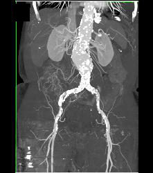 Abdominal Aortic Aneurysm (AAA) With Peripheral Vascular Disease (PVD) - CTisus CT Scan