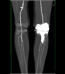 Abdominal Aortic Aneurysm (AAA) With Peripheral Vascular Disease (PVD) - CTisus CT Scan