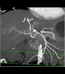 Hepatic Artery Aneurysms in Ehlers-Danlos Syndrome - CTisus CT Scan