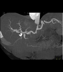 Normal Renal Arteries - CTisus CT Scan