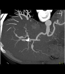 Normal Renal Arteries - CTisus CT Scan