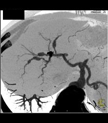 Normal Renal Arteries - CTisus CT Scan