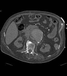 Leaking Aortic Aneurysm - CTisus CT Scan