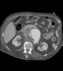 Leaking Aortic Aneurysm - CTisus CT Scan