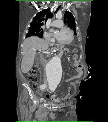 Leaking Aortic Aneurysm - CTisus CT Scan