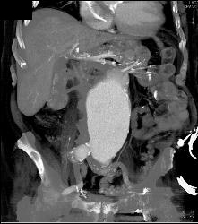 Leaking Aortic Aneurysm - CTisus CT Scan