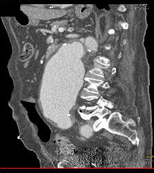 Leaking Aortic Aneurysm - CTisus CT Scan