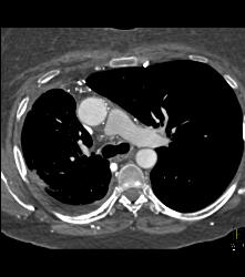 SVC Occlusion With Collaterals - CTisus CT Scan