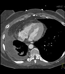 SVC Occlusion With Collaterals - CTisus CT Scan