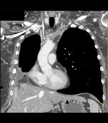 SVC Occlusion With Collaterals - CTisus CT Scan