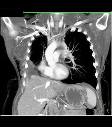 SVC Occlusion With Collaterals - CTisus CT Scan