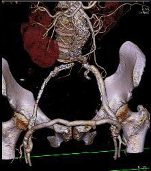 Fem-fem Bypass Graft - CTisus CT Scan