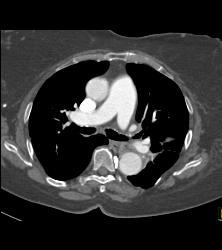 Fem-fem Bypass Graft - CTisus CT Scan