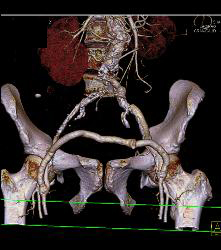 Fem-fem Bypass Graft - CTisus CT Scan