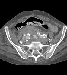 Pelvic Bleed From Iliac Aneurysm - CTisus CT Scan